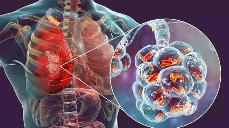 Are you short of breath while climbing stairs and your blood pressure has suddenly started falling? Know when pneumonia becomes a medical emergency