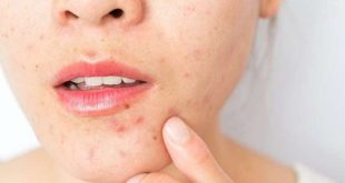 spots, face, signs, problems, body, health, skin, issues, acne, blemishes, diagnosis, symptoms, medical, conditions, hormones, diet, stress, allergies, skincare, treatment, underlying, causes, dermatology, inflammation, hygiene, lifestyle