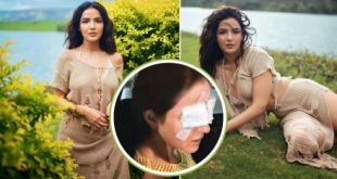 Jasmin Bhasin Facing Eyes Issues