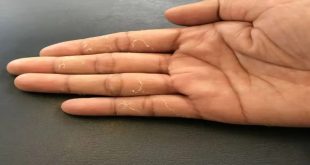 Peeling Skin During Monsoon One (1)