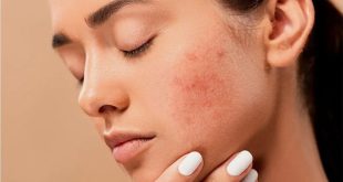 Home Remedies To Reduce Redness (1)