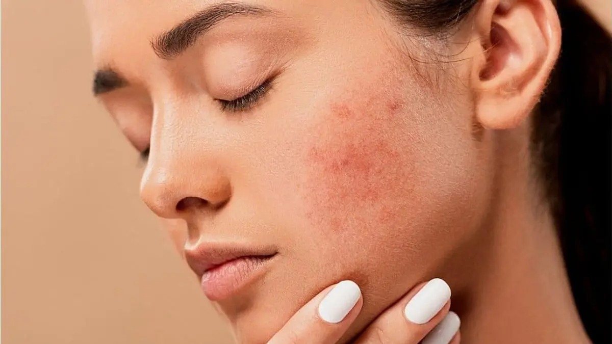 Home Remedies To Reduce Redness (1)