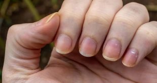 Tips To Get Rid Of Yellow Nails