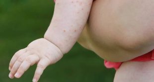 Parenting Tips Heat Rash In Babi