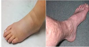 Cholesterol Symptoms In Leg Feet