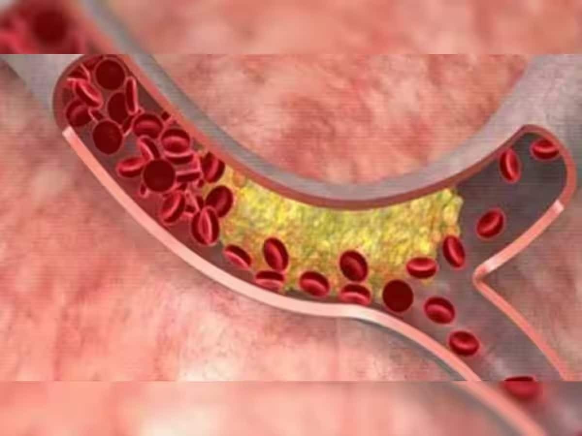 599015 Cholesterol Tips