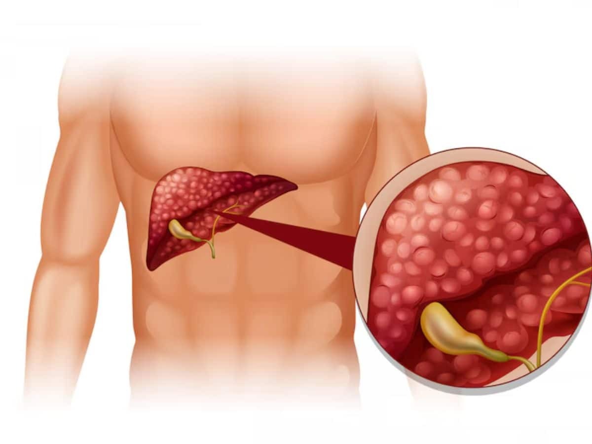 604983 Fatty Liver