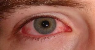 Conjunctivitis Pink Eye Symptoms