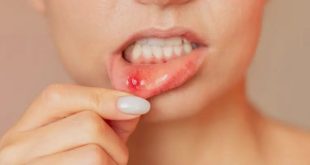 Mouth Ulcer 768x432.jpg