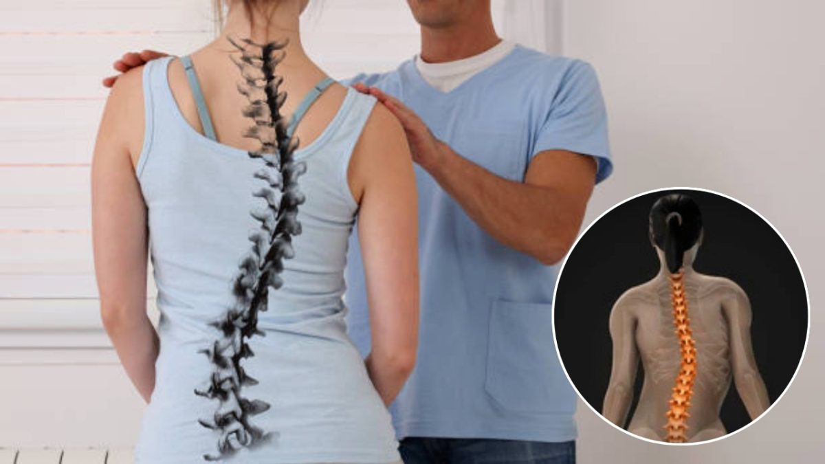 Spine Scoliosis, Causes of scoliosis, what is scoliosis, idiopathic scoliosis, symptoms of scoliosis, how to get relief from scoliosis