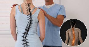 Spine Scoliosis, Causes of scoliosis, what is scoliosis, idiopathic scoliosis, symptoms of scoliosis, how to get relief from scoliosis