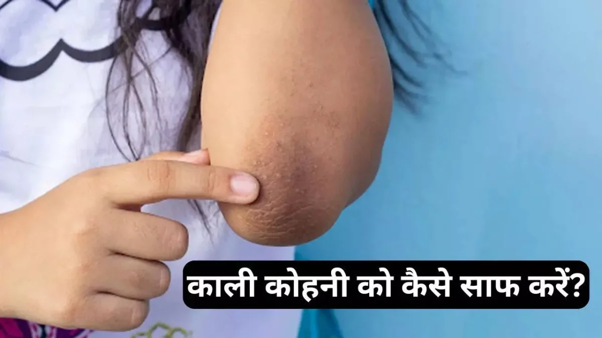 3 best home remedies to remove dark elbows