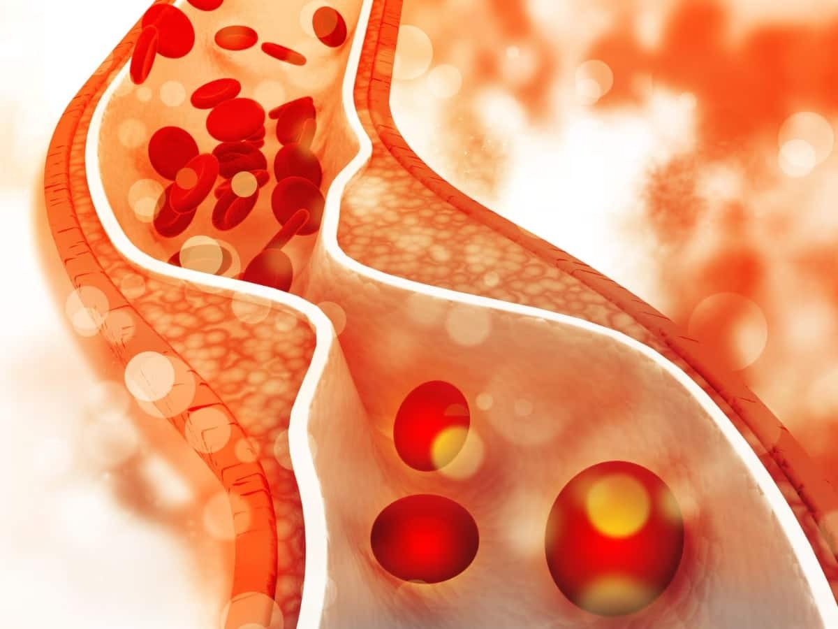 619032 Ldl Cholesterol