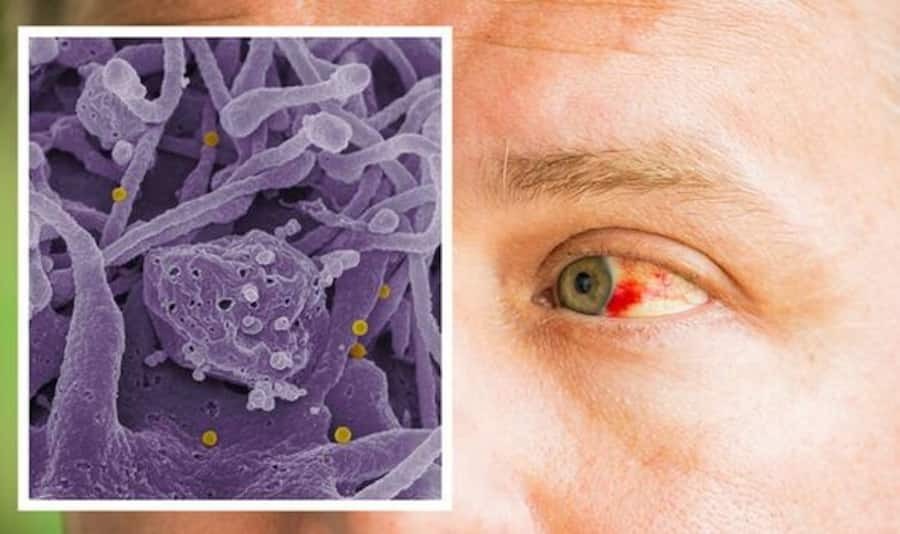 Deadly Eye Bleeding Virus Infect