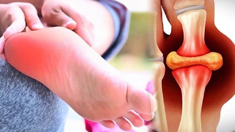 सर्दियों में यूरिक एसिड की समस्या से छुटकारा पाने के लिए अपनाएं ये टिप्स