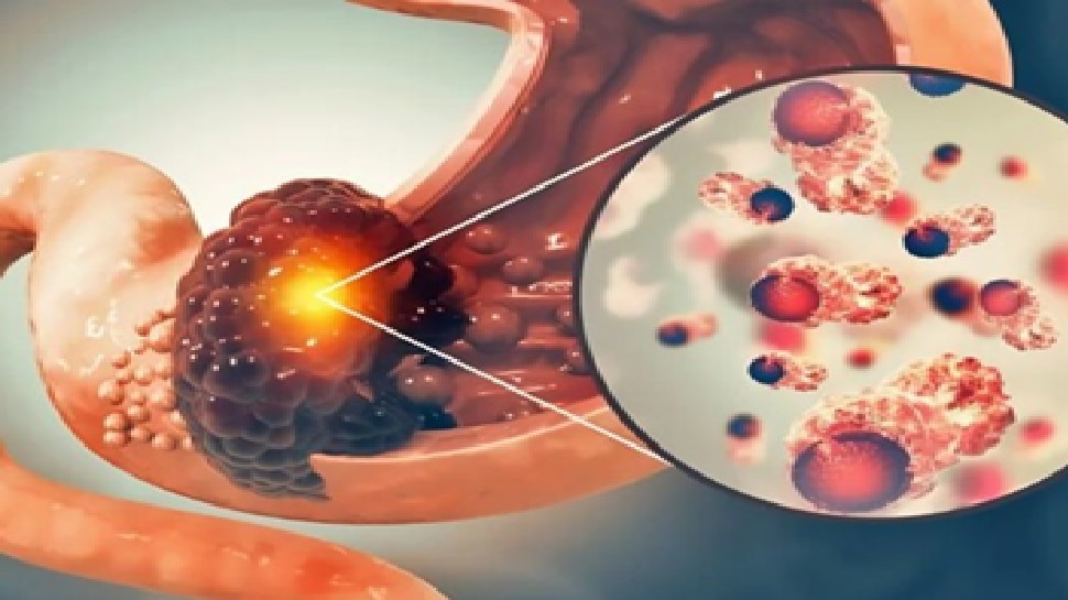 अगर आपके शरीर में ये लक्षण दिखें तो समझ लीजिए आपको गैस्ट्रिक कैंसर